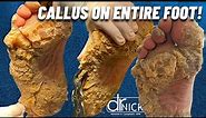 SHAVING CALLUS ON ENTIRE SOLE OF FOOT!!! Dr. Nick Campitelli, Foot & Ankle Surgeon