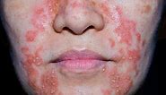 Atopic Dermatitis and Other Types of Eczema In Pictures