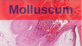 Molluscum Contagiosum - Pathology mini tutorial