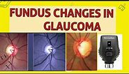 OPTIC DISC CHANGES IN GLAUCOMA