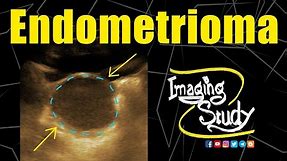 Endometrioma - Chocolate Cyst || Ultrasound || Doppler || Case 148