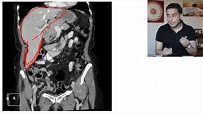 Riedel's lobe of the liver | Accessory liver lobe