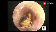 Earwax Removal Extraction, Cholesteatoma of the middle ear canal, exfoliate of tympanic membrane,