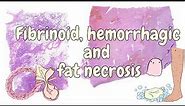 Fibrinoid, hemorrhagic and fat necrosis - general pathology