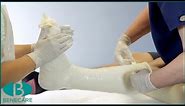 How to Apply a Below Knee Cast Using Plaster of Paris
