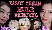 Organic Kasoy Cream || Mole Removal Journey...😱😱😱