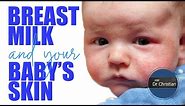 Can BREASTMILK upset your baby's SKIN? (Could there be an ALLERGY?)