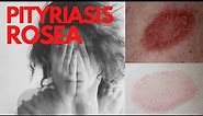 PITYRIASIS ROSEA - Answers of the common questions about Pityriasis Rosea- What is Pityriasis rosea?