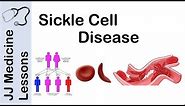 Sickle Cell Disease | Pathophysiology, Symptoms and Treatment