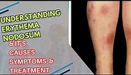 "Understanding Erythema Nodosum: Causes, Symptoms, and Treatment"
