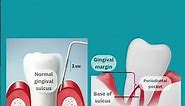 Gingival recession, Pocket and clinical attachment loss