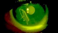 Fluorescein eye stain