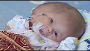 Parents Pray for Miracle After Their Baby Is Born With 2 Faces