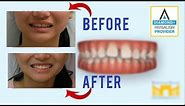 Invisalign Before and After: Gap in Teeth