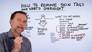 How to Remove Skin Tags and Warts Overnight