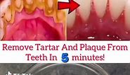 Remove Tartar And Plaque From Teeth In 5 minutes!👌✨ Baking soda 1tbsp,Coconut oil 1tbsp,mix well, Apply the mixture on your teeth using a toothbrush, Brush your teeth for 2 minutes then rinse with normal water, Use this remedy 3 times a week. #teeth #teethwhitening #teethcare #teethcleaning #teethtok #teething #teethcareroutine #teethcaretips #beauty ##teethtartar #fy #fyp #fypシ #teethplaqueremoval #fypシ゚viral #foryou