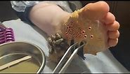 Removing TICKS and WORMS from the foot - trypophobia