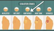 How To Treat A Blister Correctly (First, Look At Your Blister Roof)