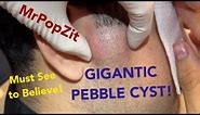 GIANT PEBBLE CYST in face.You haven’t seen one like this before! Perfect example of a Pilomatricoma