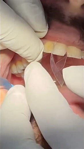 Placing the Transparent Matrix Band 🦷 | Real Dental Procedure