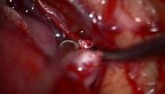 Aneurysm Clip Surgery - Middle Cerebral Artery