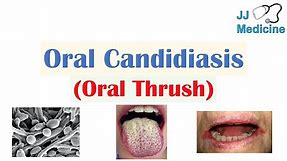 Oral Candidiasis (Oral Thrush) | Causes, Pathophysiology, Signs & Symptoms, Diagnosis, Treatment