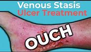 Venous Stasis Ulcer Treatment | Wound Care OC