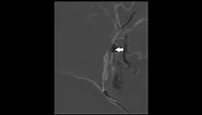 Nuances of carotid artery stenting under flow arrest with dual-balloon guide catheter