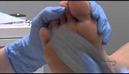 How to Remove Callus | Foot Callus Remover