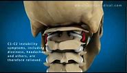 C1 and C2 Atlantoaxial Instability: Upper Cervical Instability and Prolotherapy animation