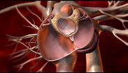 What is PFO? | Closure of Patent Foramen Ovale to treat Cryptogenic Stroke