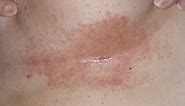 DermTV - How to Treat Under Breast Rashes & Infections [DermTV.com Epi 190]