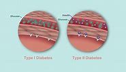 What's the Difference Between Type 1 and Type 2 Diabetes? | Diabetes Center