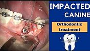 IMPACTED CANINE exposure treatment with ORTHODONTICS and braces - Step by step