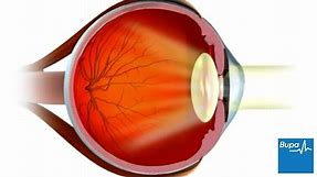 How LASIK eye surgery is carried out