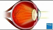 How LASIK eye surgery is carried out