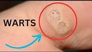 GET RID OF WARTS: Here's How!