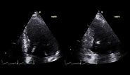 2-D Echocardiographic Morphology of End-Diastolic and End-Systolic Volume