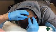 Removal of a small pilar cyst on the scalp