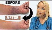How to Treat ECZEMA | Black Brown skin | Dry Skincare Routine| The #1 Best Remedy for Eczema