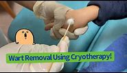 Cryotherapy For Kids | Liquid Nitrogen For Warts Removal | How to Remove A Wart | Kids Warts Removal