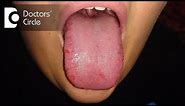 Lesions of tongue causes and management - Dr. Pujari M R