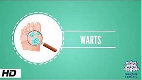 Wart, Causes, Signs and Symptoms, Causes, Diagnosis and Treatment.