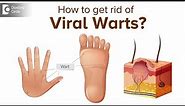 What are Viral Warts and what do we need to know about it? - Dr. Divya Sharma|Doctors' Circle
