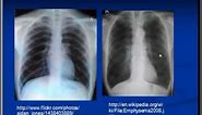 Chest x-ray interpretation --COPD and Emphysema
