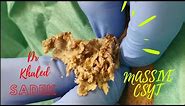Massive Armpit Cyst. Dr Khaled Sadek. LipomaCyst.com