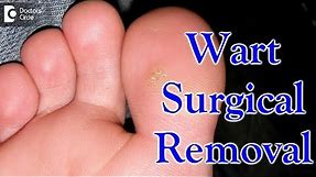 Wart surgical removal - Dr. Urmila Nischal