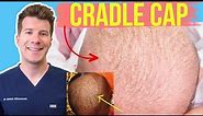 Doctor explains CRADLE CAP (Seborrheic dermatitis) in babies & infants | Photos and home treatment!