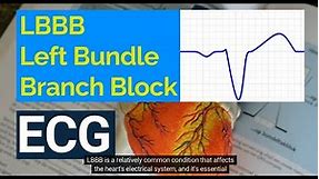 Understanding Left Bundle Branch Block (LBBB) on ECG: Causes, Symptoms, and Treatment.