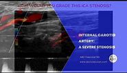 Severe stenosis of the internal carotid artery: ultrasound diagnostic criteria